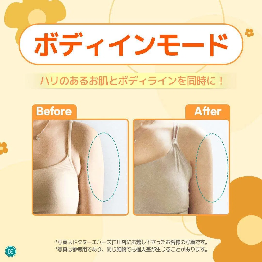 施術情報】ボディインモードでダウンタイムなしに楽に部分痩せ 