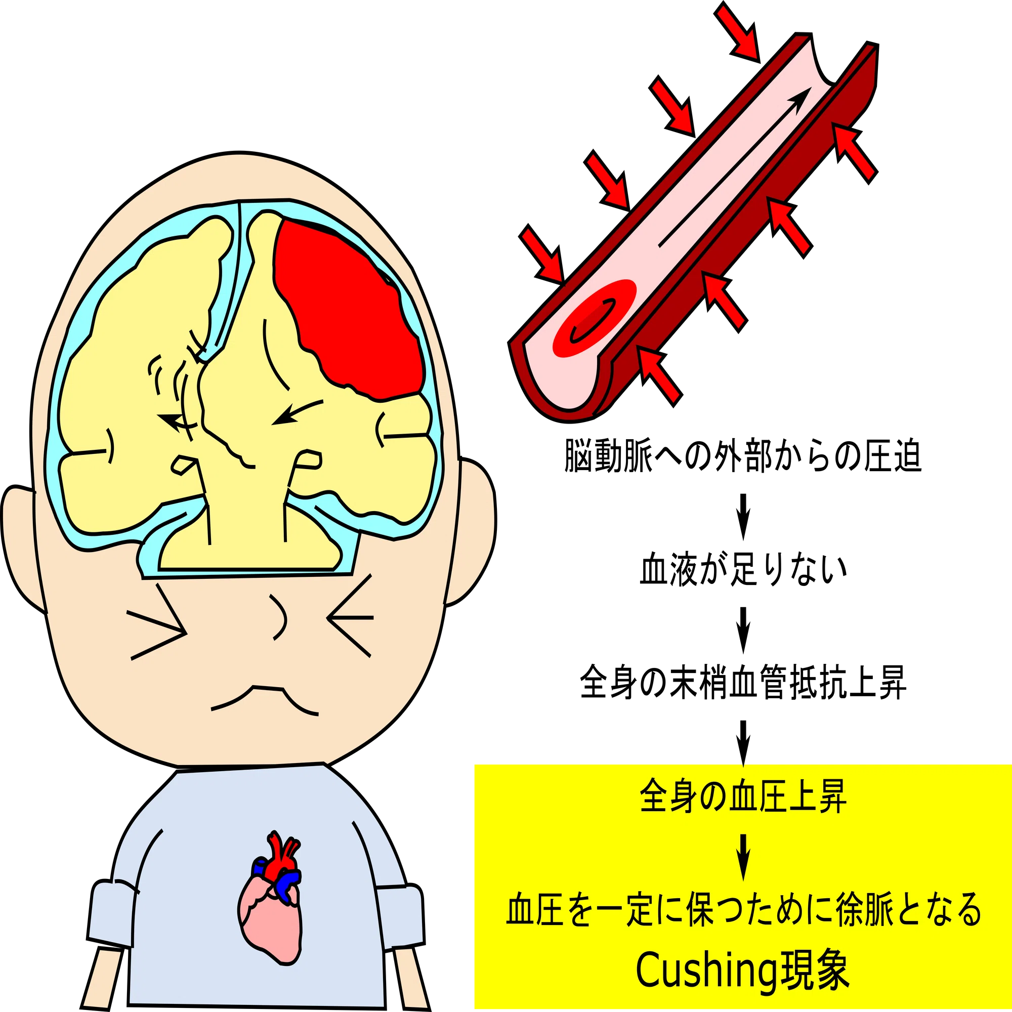 脳 ヘルニア 症状