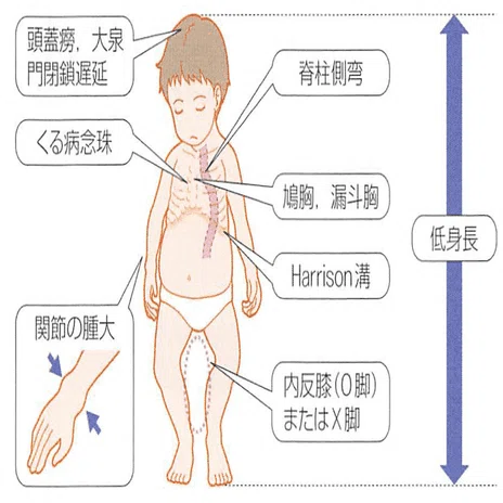 整形外科専門医試験2025年第37回問1｜Drひろひろ@整形外科専門医試験対策