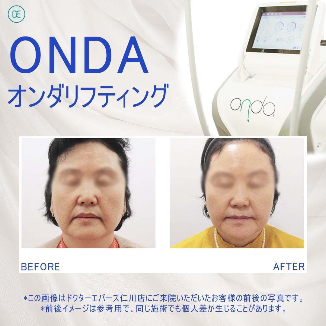 施術情報】痛みゼロ！オンダリフトの凄さって？｜韓国美容皮膚科