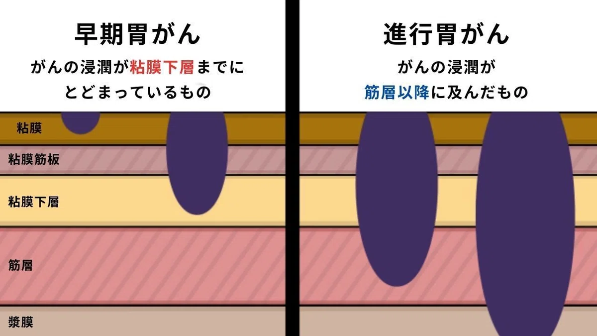 【胃がんの症状や特徴】イラスト図解でわかりやすく解説!|おがちゃん先生/解剖生理