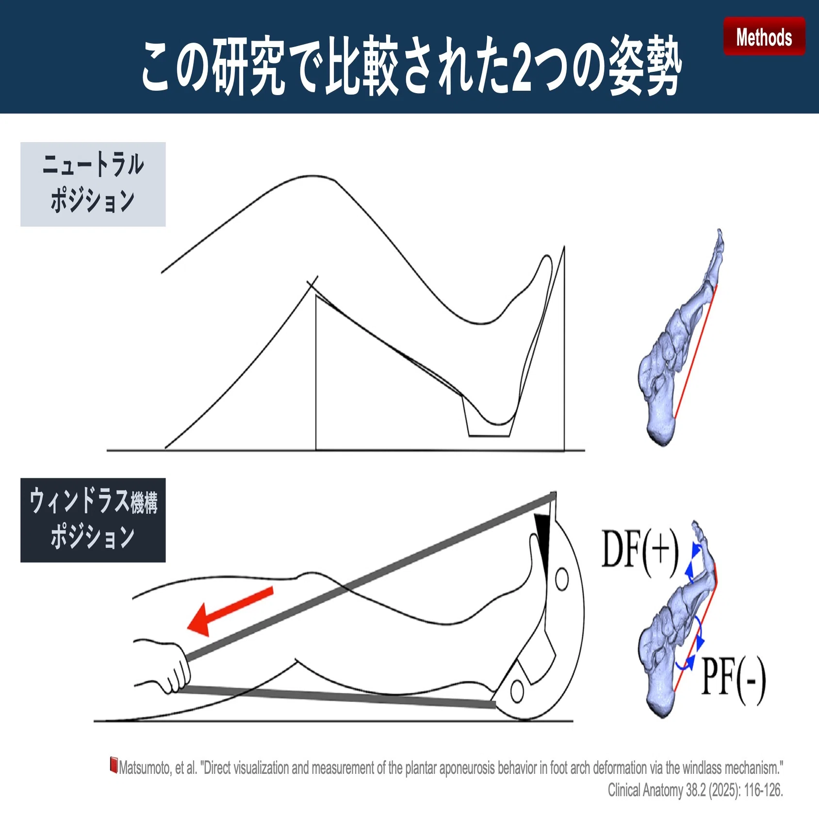 ウィンドラス機構で足底腱膜に起きていること｜Super Human | 理学療法 