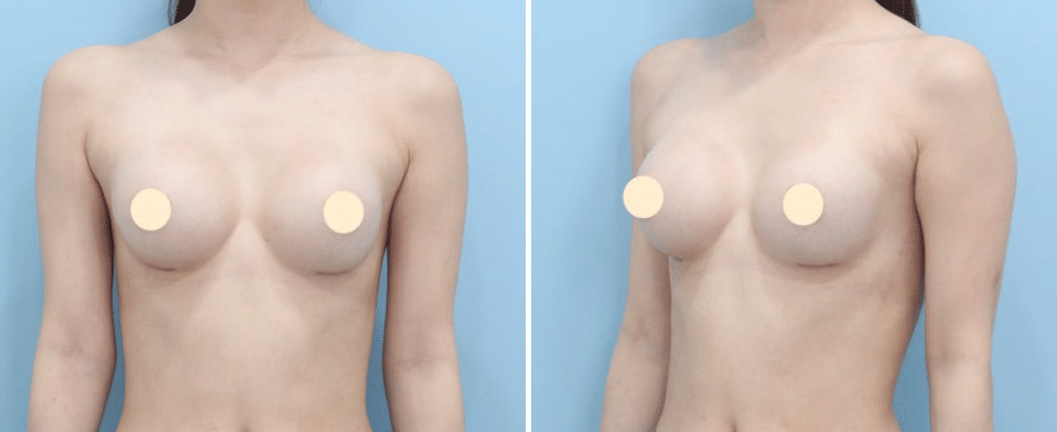 EVERA　韓国　美容　豊胸　美容整形　エベラ ✓NANAベラジェル豊胸術 胸についてお悩みの方❣❣ ファン院長は