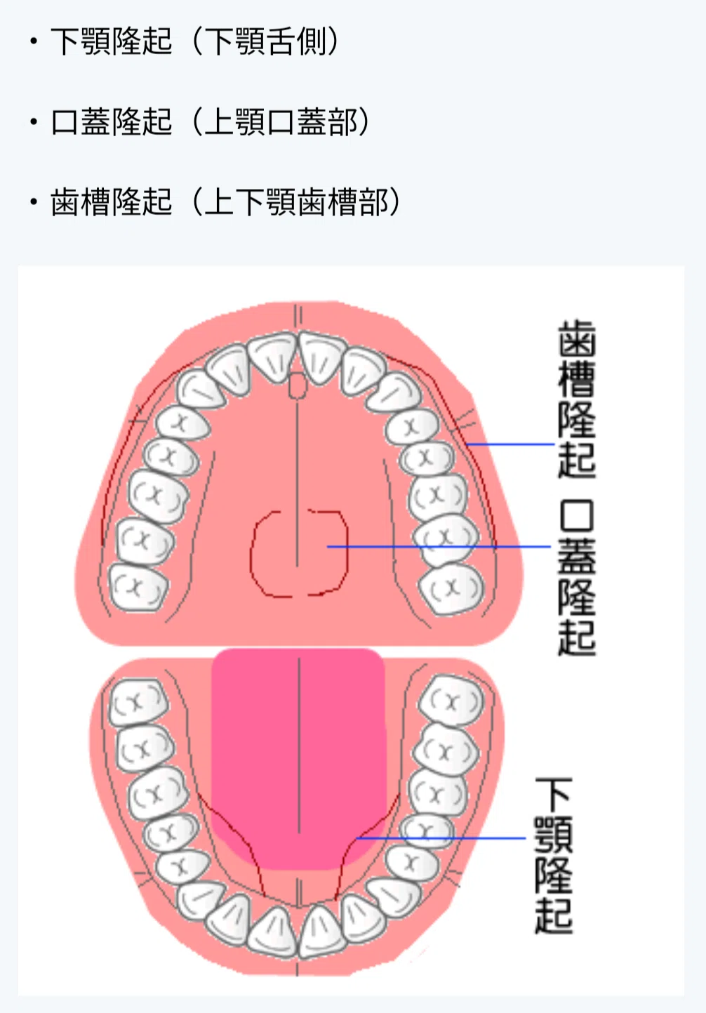 【体験レポ】40代歯列矯正|コラム|上あご裏のボコボコ 骨隆起について|つまこ