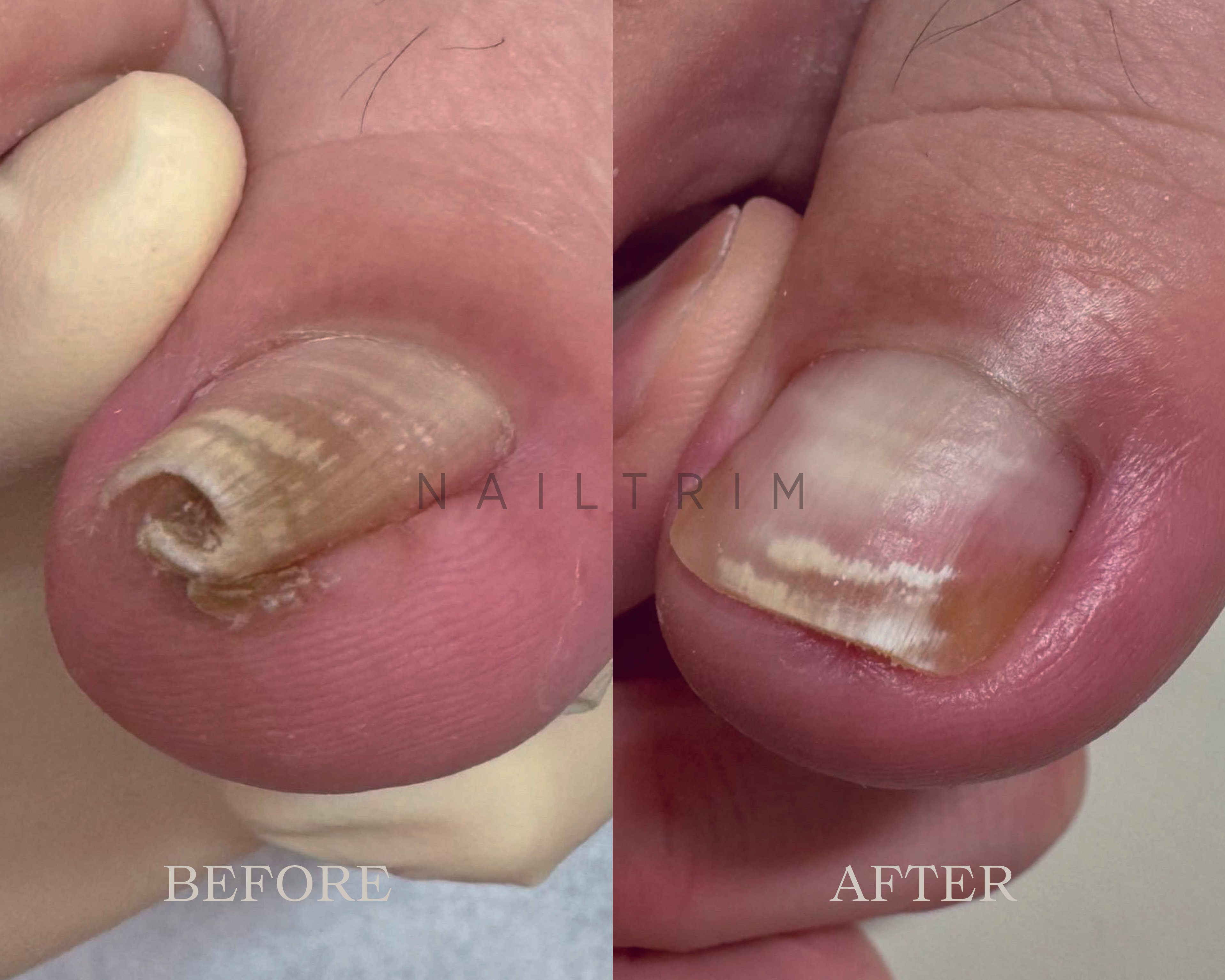 巻き爪や様々な爪トラブルを解決する専門技術「Nailtrim®︎」。 その