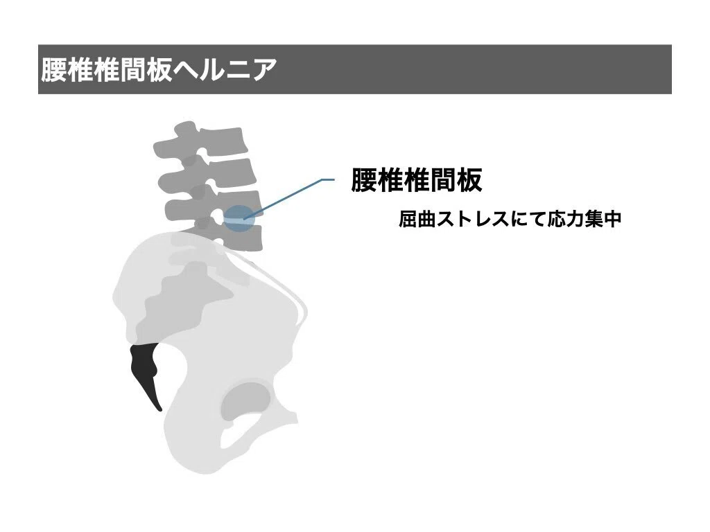 腰痛の評価・アプローチ.2025｜平 純一朗｜理学療法士×アスレティック