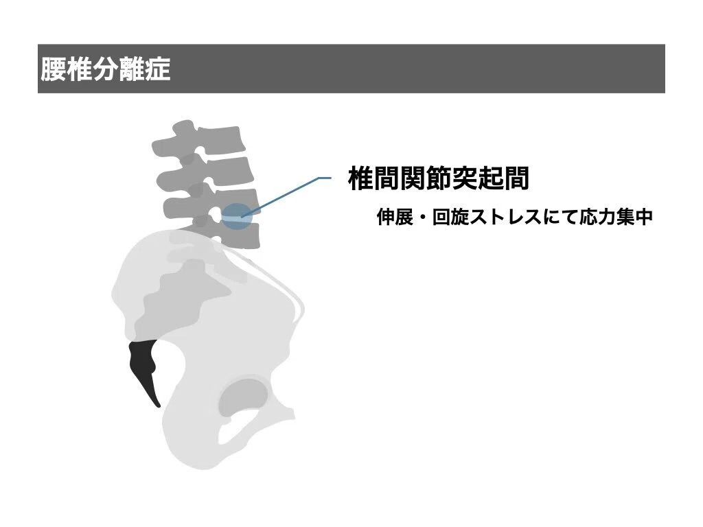 腰痛の評価・アプローチ.2025｜平 純一朗｜理学療法士×アスレティック