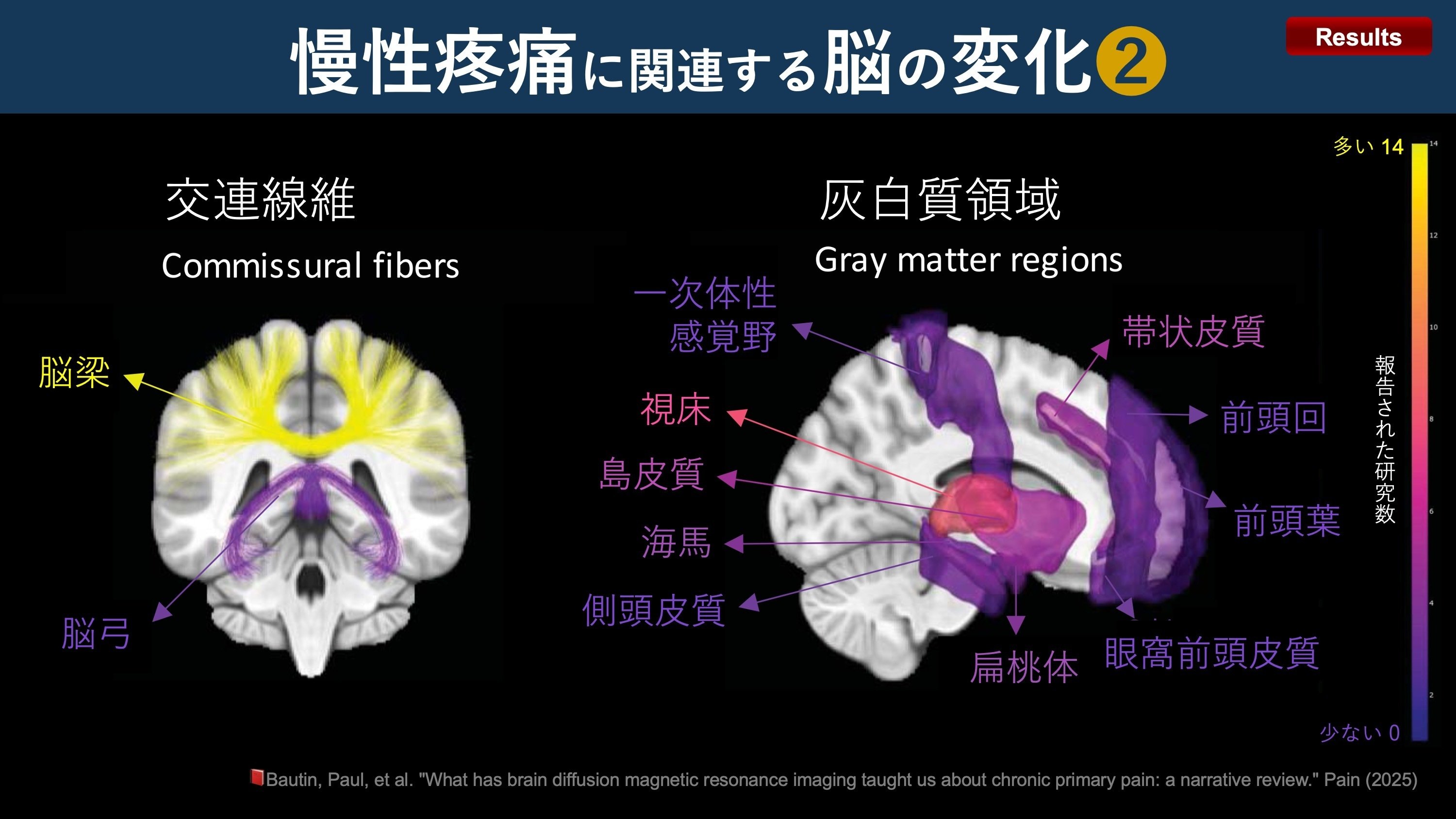 大脳白質解剖入門 = An Introduction of Fiber Dis… 大脳白質解剖入門(An Introduction of Fiber Dissection