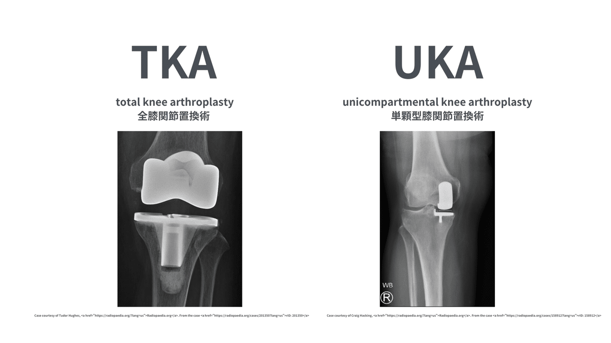 教科書　TKA UKA 人工膝関節置換術パーフェクト TKA・UKA 人工膝関節置換術パーフェクト〜人工膝関節全置換術