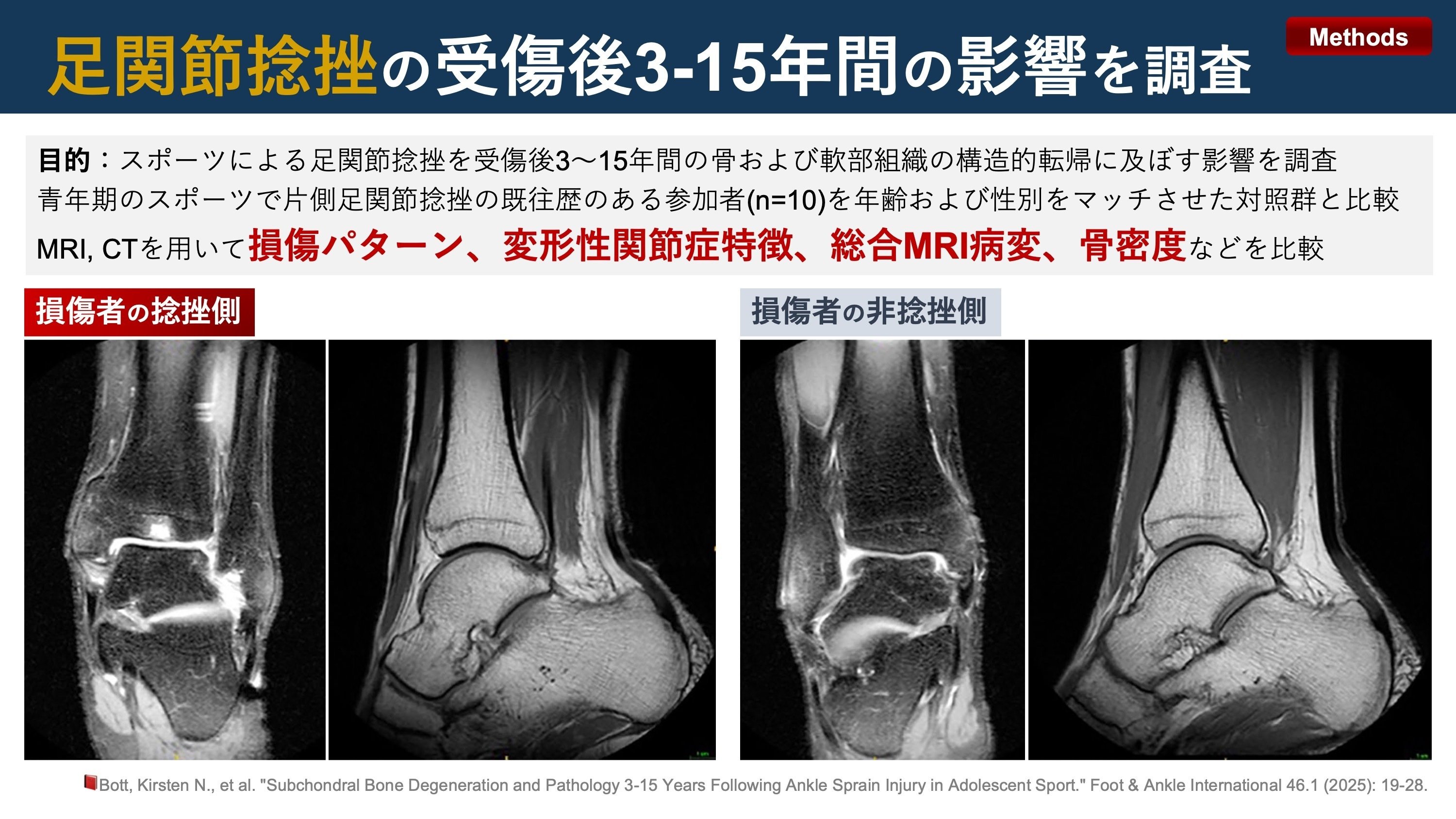 関節唇および肩甲上腕靱帯の正常変異とMRI画像所見のポイント