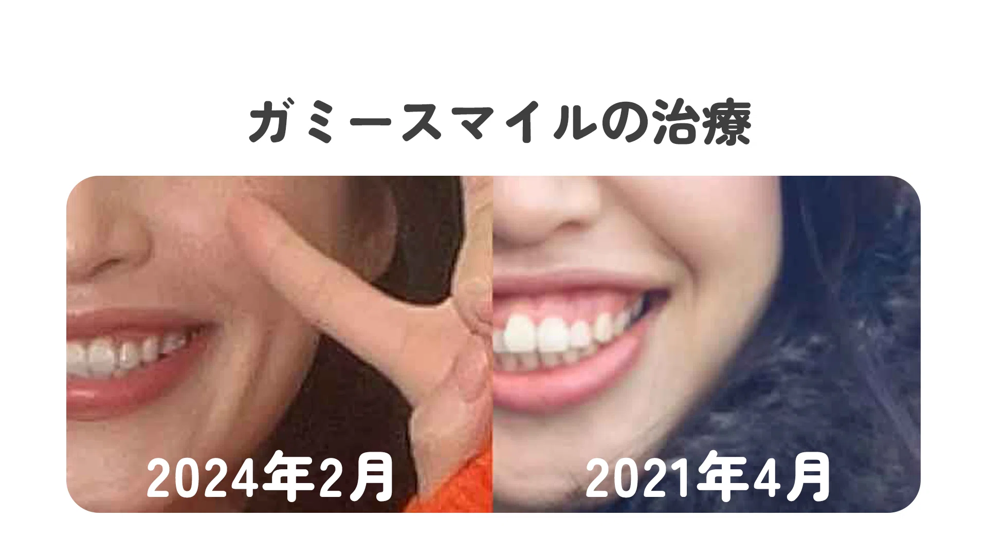 歯列矯正㉑】2年11ヶ月経過報告。ガミースマイルの話。｜Midori｜歯列