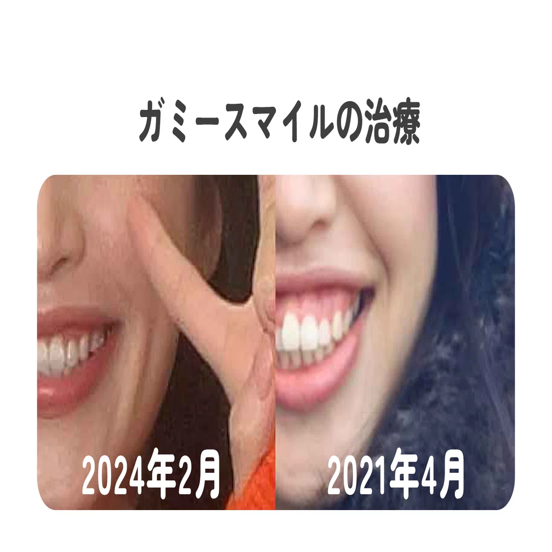 歯列矯正㉑】2年11ヶ月経過報告。ガミースマイルの話。｜Midori｜歯列