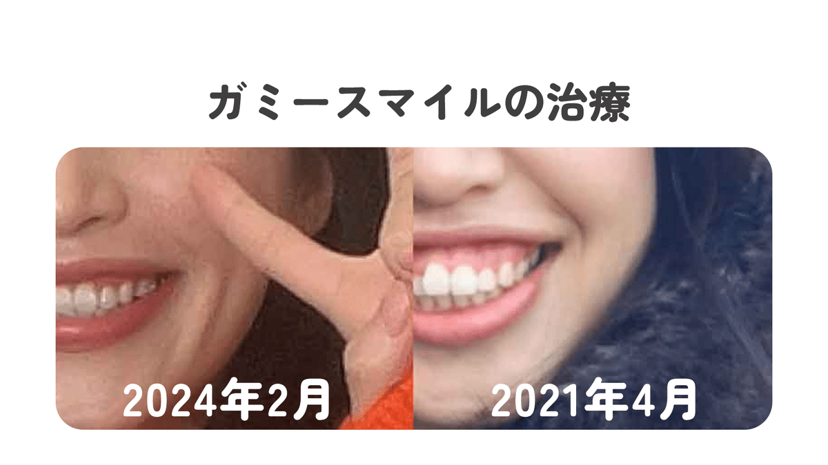 歯列矯正㉑】2年11ヶ月経過報告。ガミースマイルの話。｜Midori