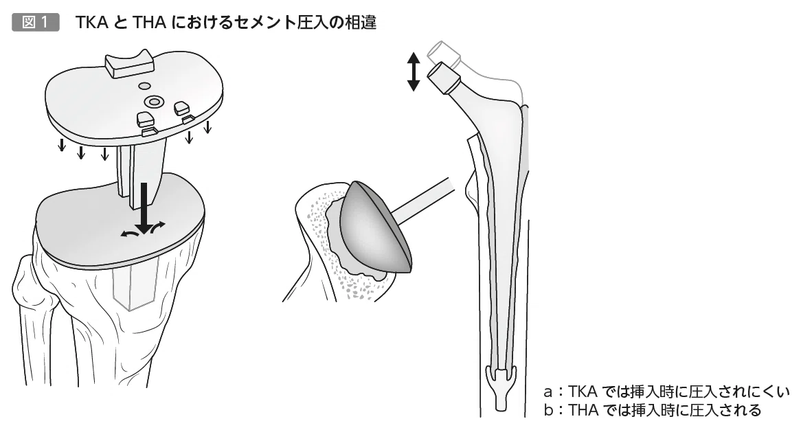 包括臨床に活かすMTM 第7回 TKA surgeon が知っておくべきセメントの知識：備えよ常に