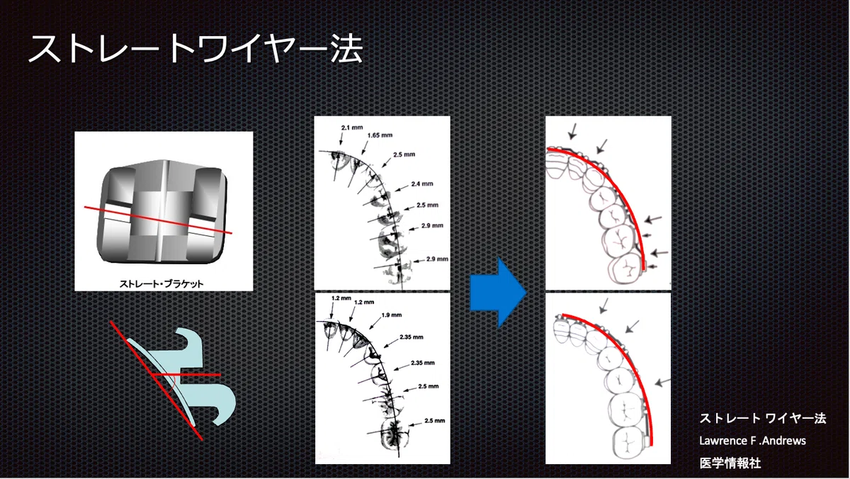 最新リンガルストレートワイヤー法 = NEW LINGUAL STRAIGHT 【公式通販】