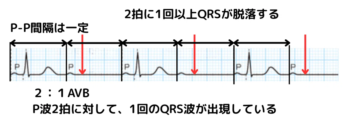 【心電図で学ぶ】房室ブロック（AVB）の分類とペースメーカー設定の基本｜ヒロの心電図ノート