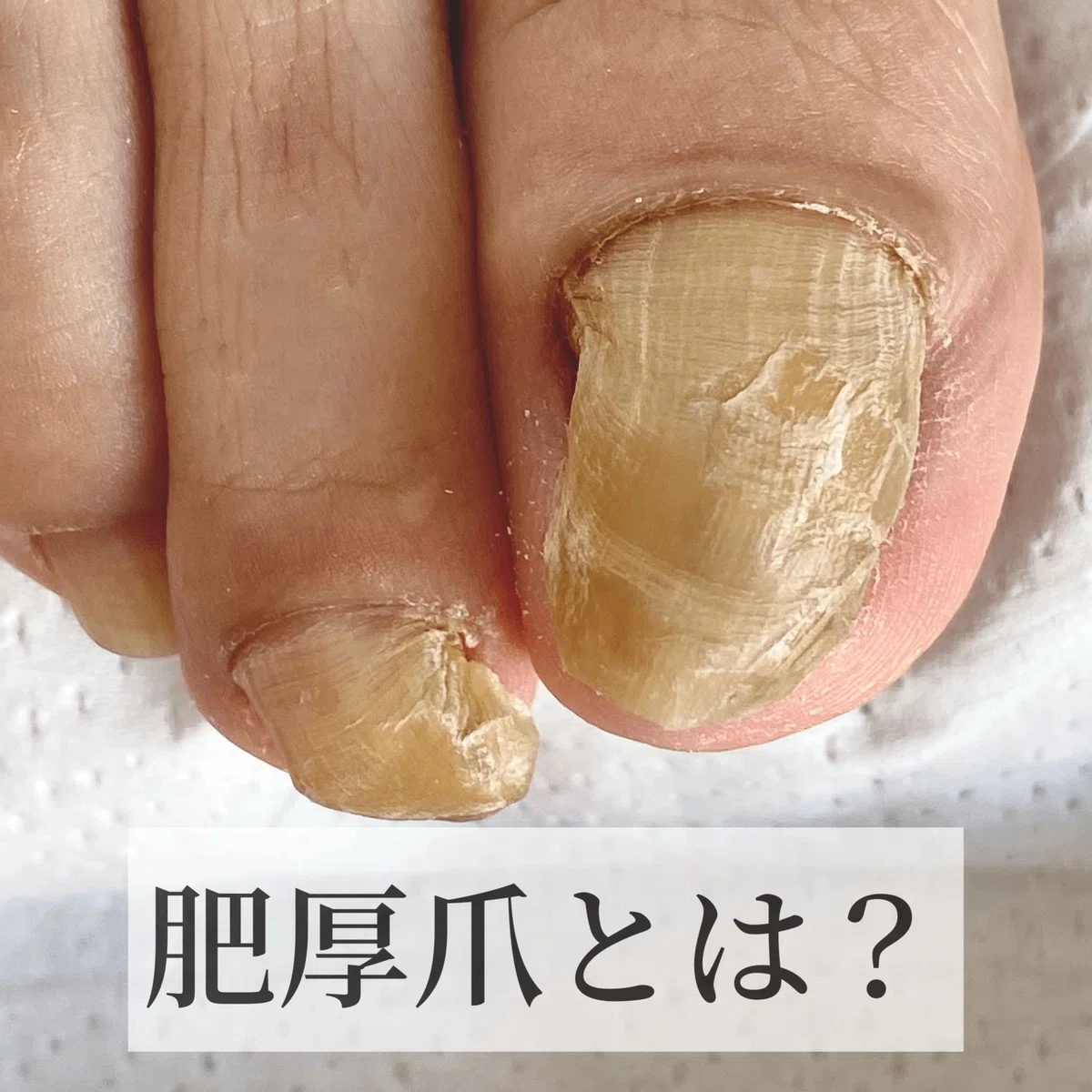 皮膚科で断られる肥厚爪もケアできます!|爪の美容院 Cuore クオーレ