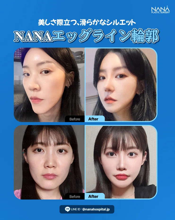 この春、もっと理想の自分に♡ NANA美容外科“春割”美容整形応援フェア