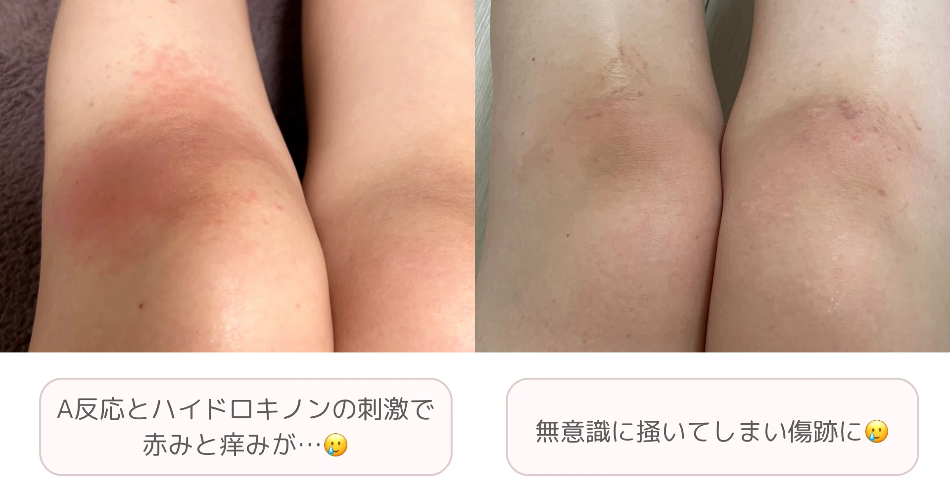 膝 の 黒ずみ