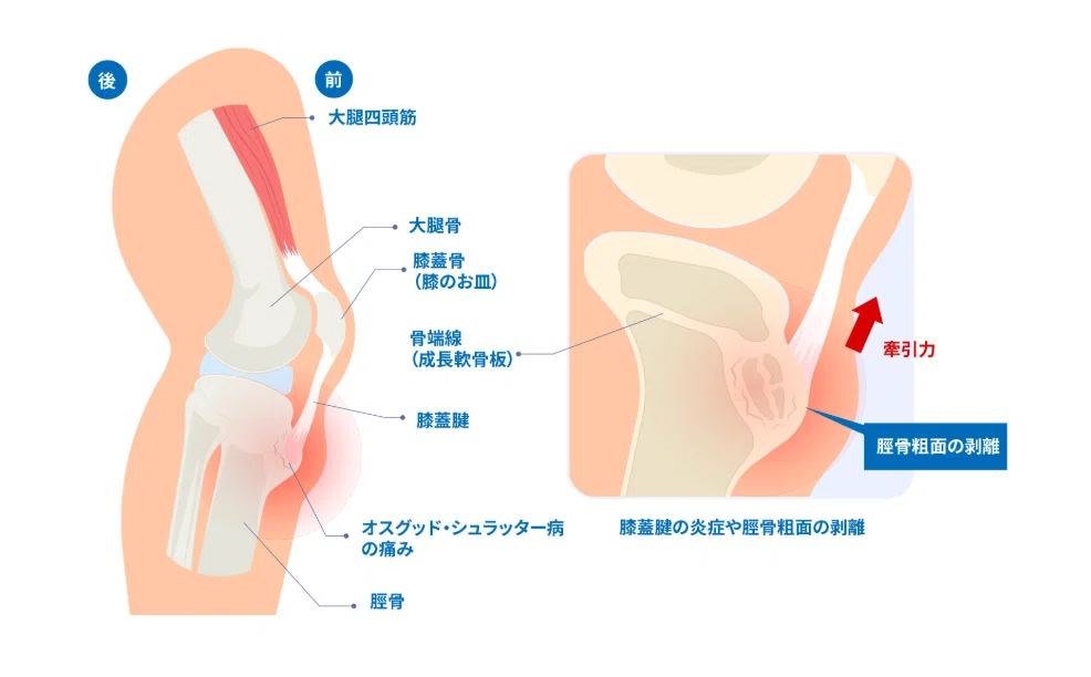 オスグッド・シュラッター病における脛骨粗面の炎症部位を示す図