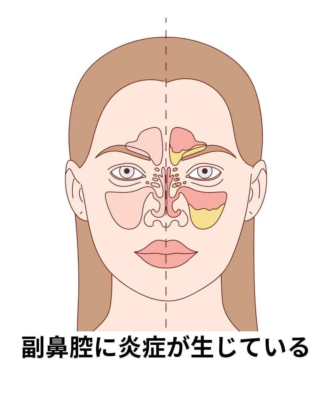 【耳鼻科専門医が解説】副鼻腔炎とは?原因・種類・治療・手術・合併症まで徹底解説!|allergy_nose_lab【専門医が伝える正しい話】