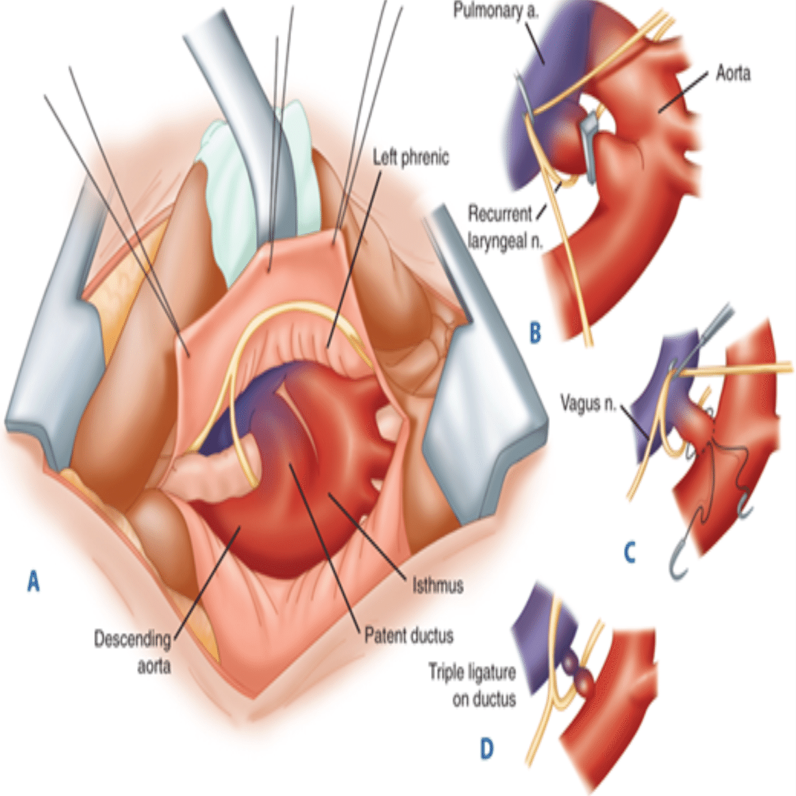 イラストでわかる実施困難症例の大動脈ステントグラフト Visualizatio… イラストでわかる実施困難症例の大動脈ステントグラフト Visualizatio…