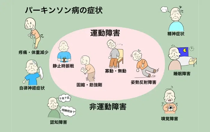 パーキンソン病の代表的な症状