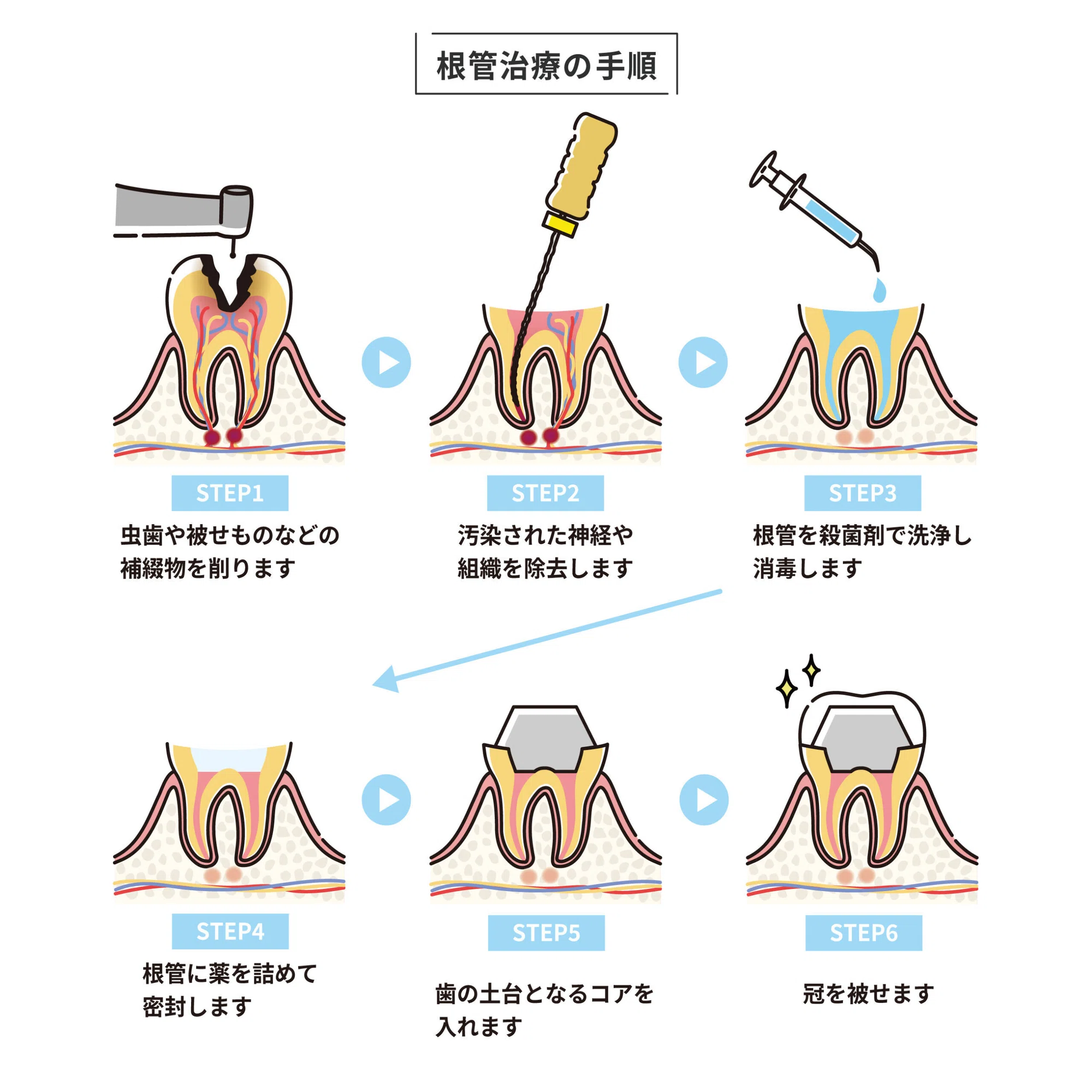 神経 を 抜い た 歯 の 寿命