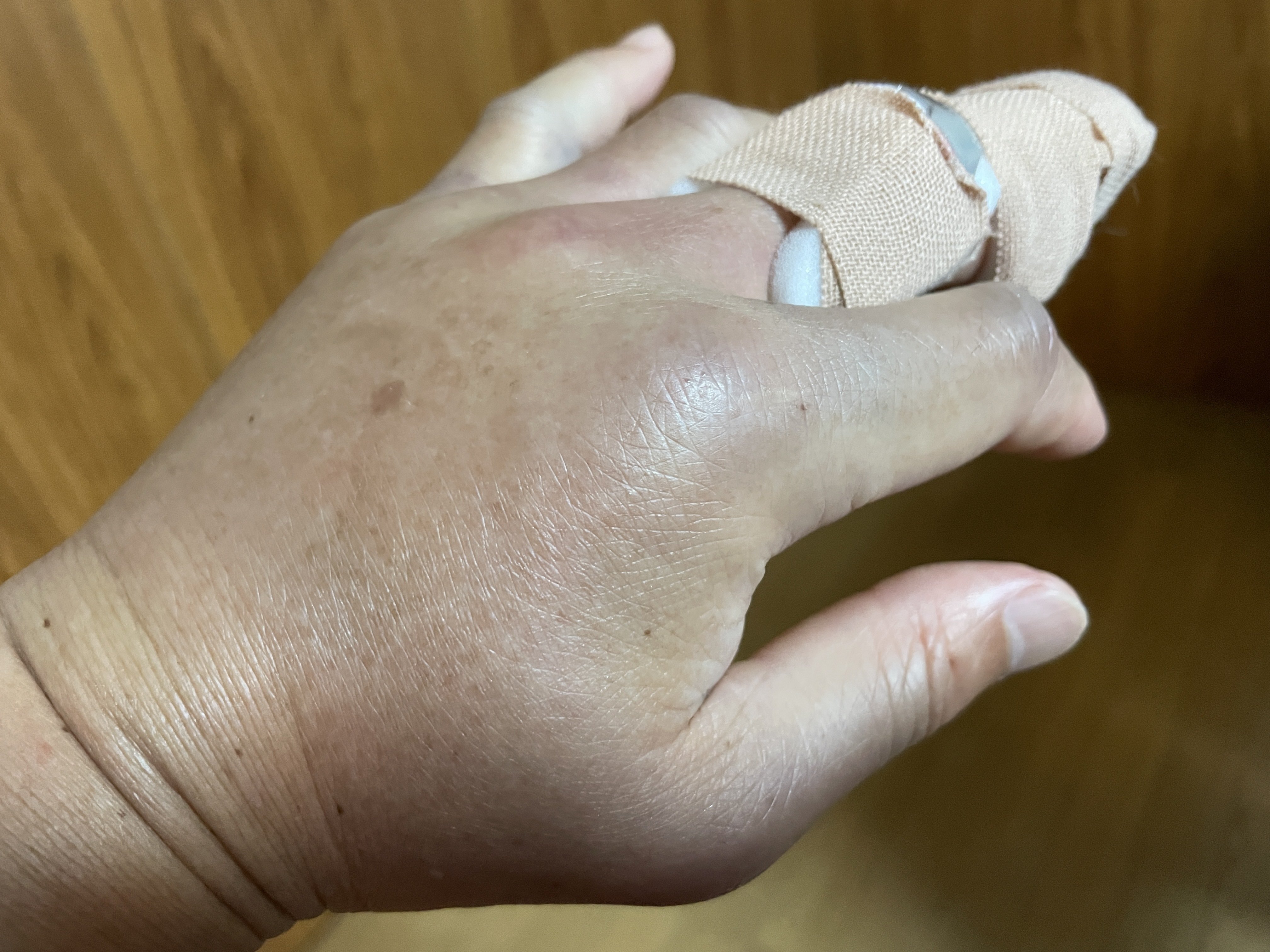 中指の骨折｜akira@fuchu