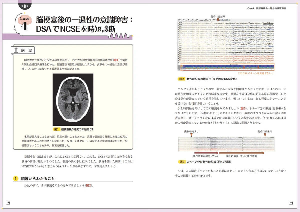 脳波超入門: 脳波判読の基礎からレポート、頭蓋内脳波まで／「読みどころ」が分かる解説動画付き！ 脳波超入門: 脳波判読の基礎からレポート、頭蓋内脳波まで