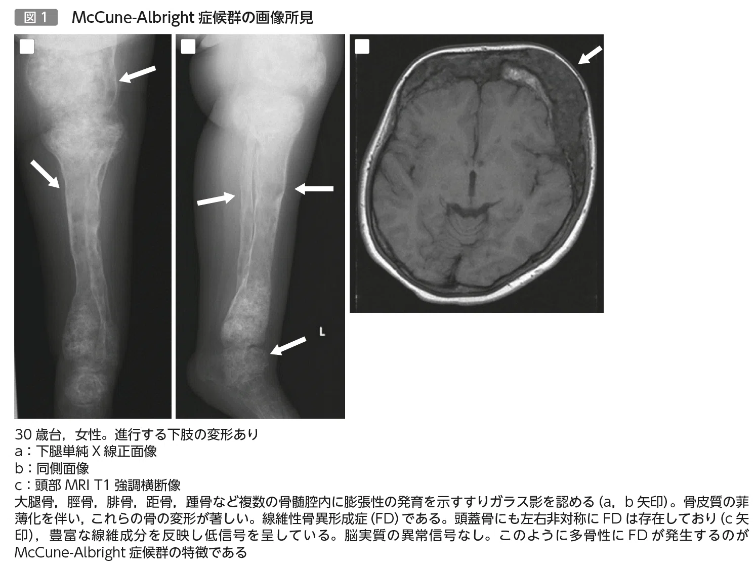 第35回 線維性骨異形成の最初の発見者：AlbrightとMcCuneの功績