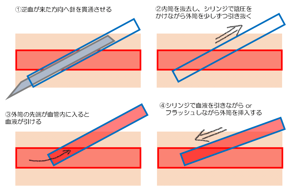 貫通法での末梢血管確保｜Yuri
