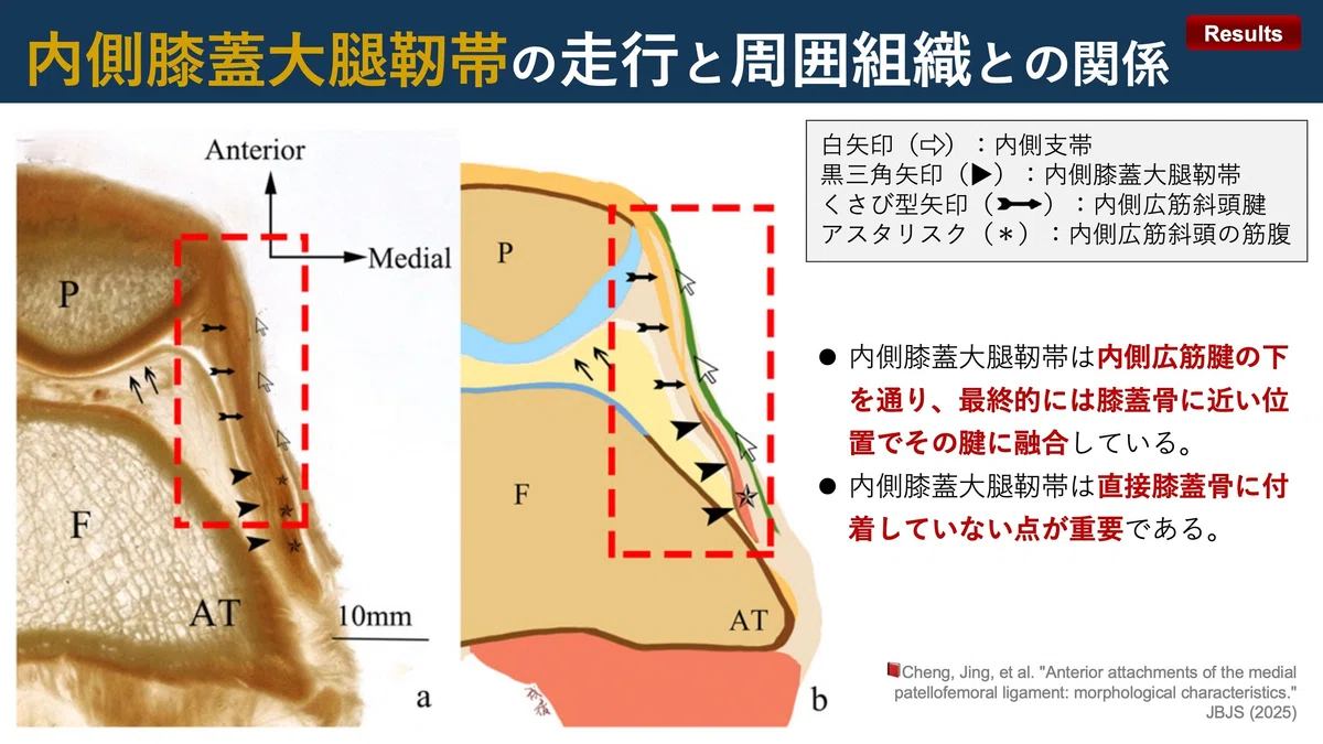 内側膝蓋大腿靭帯の前方付着部|Super Human | 理学療法士/保健学博士 Ph.D.