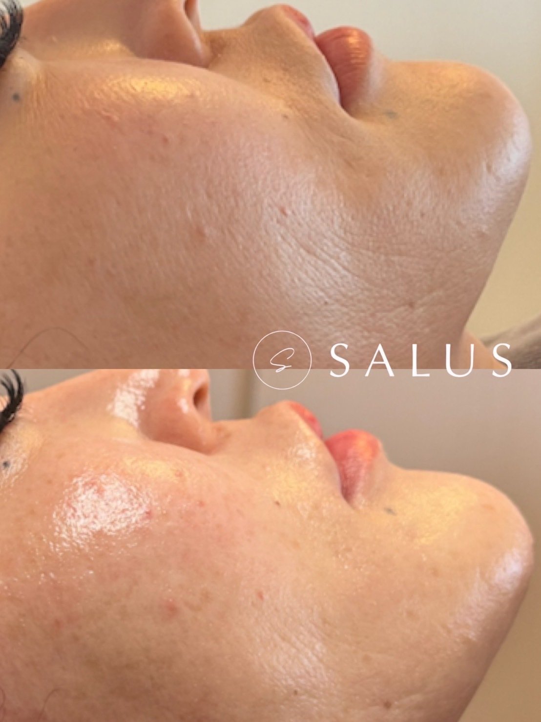 スーパージェクションの効果】SUPERJECTIONの施術が受けられるサロンは