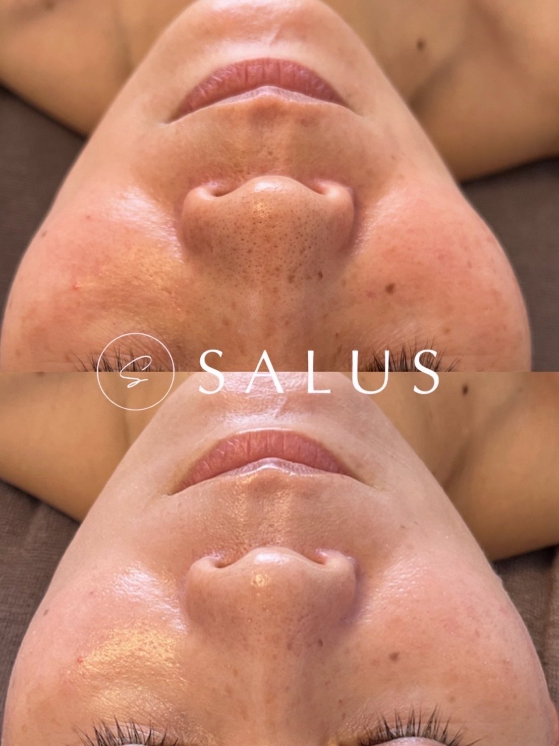 スーパージェクションの効果】SUPERJECTIONの施術が受けられるサロンは