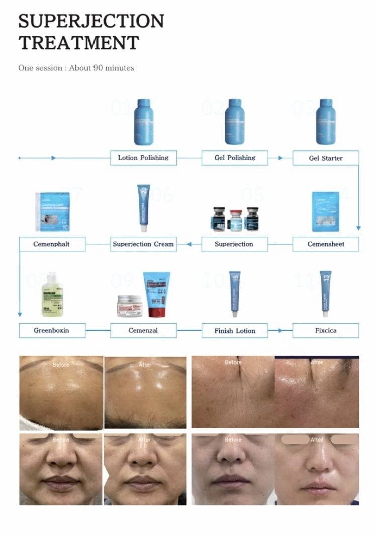 スーパージェクションの効果】SUPERJECTIONの施術が受けられる