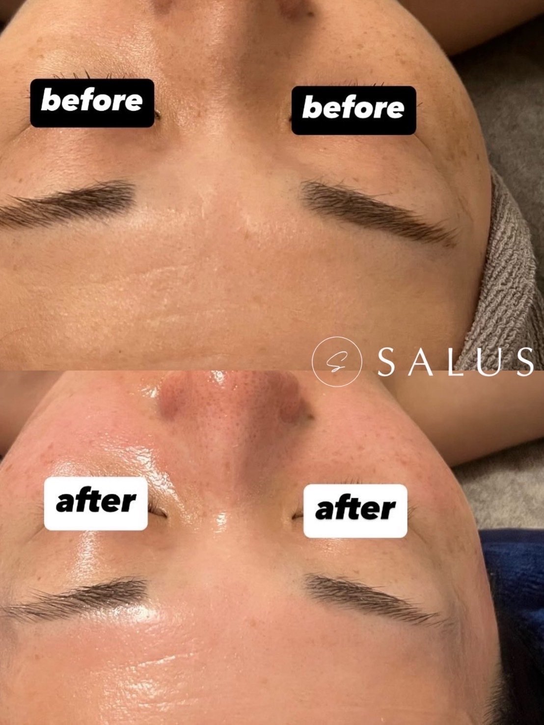 スーパージェクションの効果】SUPERJECTIONの施術が受けられるサロンは