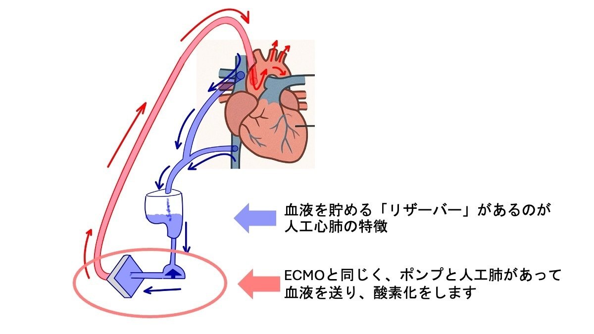 人工心肺とは？ -心臓手術での役割や流れを実臨床にあわせて、やさしく