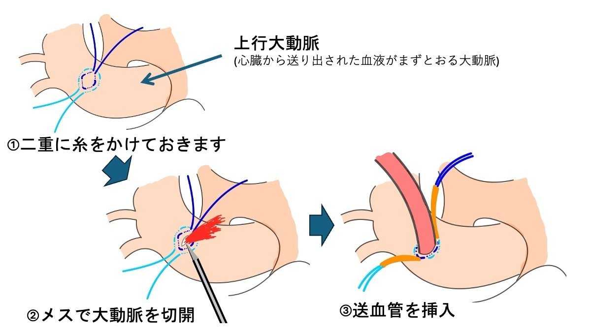 人工心肺とは？ -心臓手術での役割や流れを実臨床にあわせて