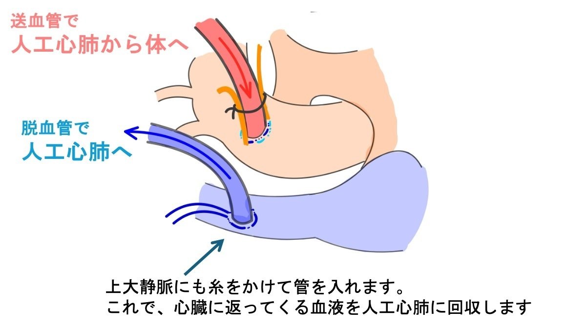 人工心肺とは？ -心臓手術での役割や流れを実臨床にあわせて