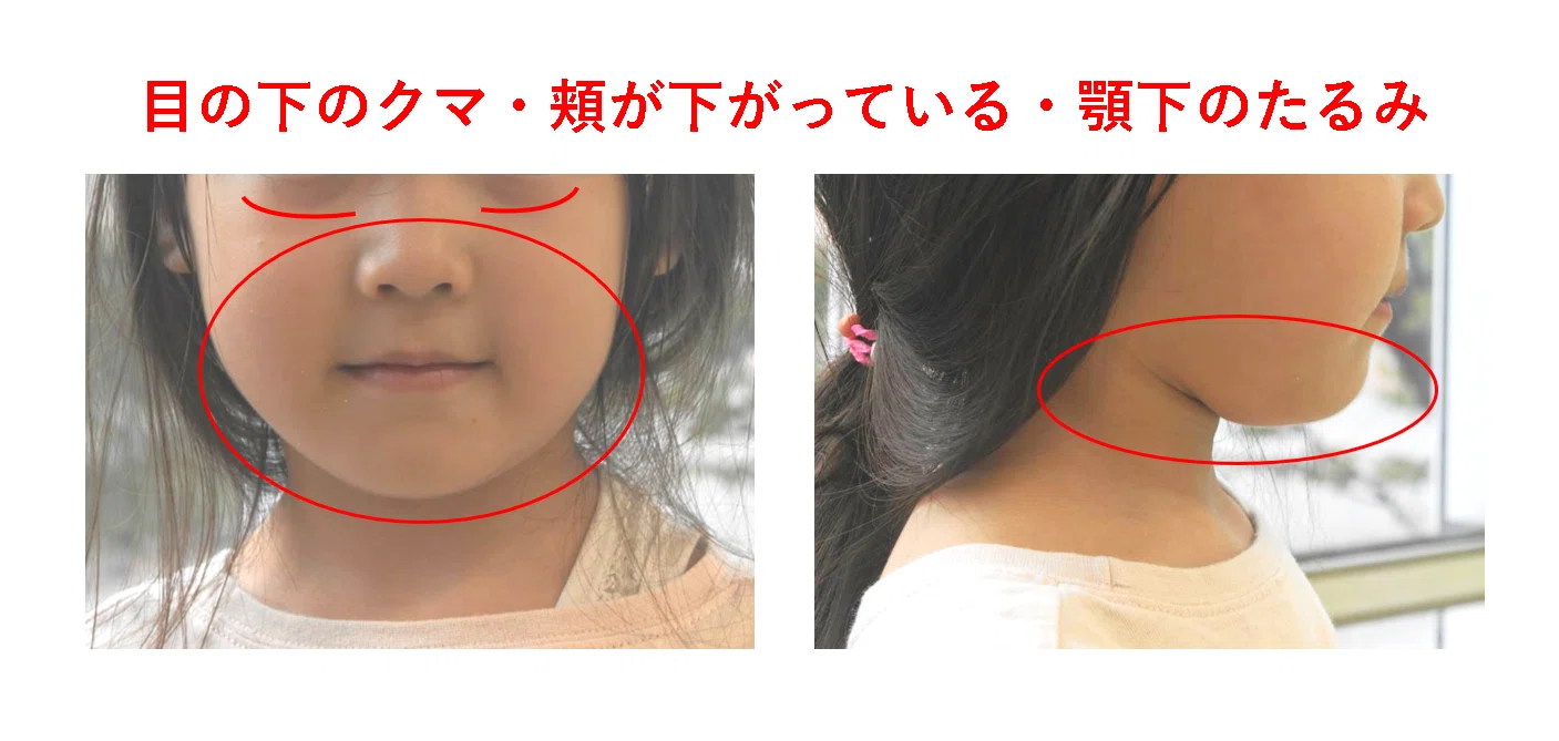 口 呼吸 顔つき