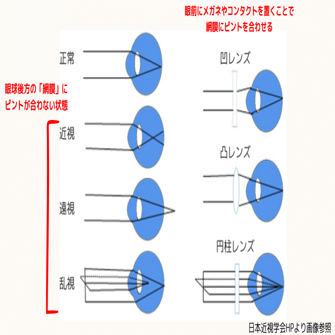 後編】屈折異常とは？近視・遠視・乱視のしくみ｜eye_mama
