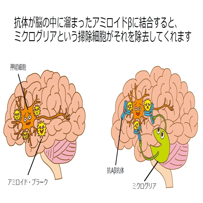 認知症治療と向き合うときに考える「人生の最期」―脳神経内科医・岩田