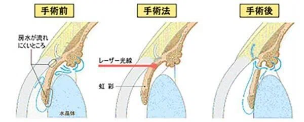 虹彩光凝固術の施術を受けました ＜ 閉塞隅角緑内障の発作を防ぐ