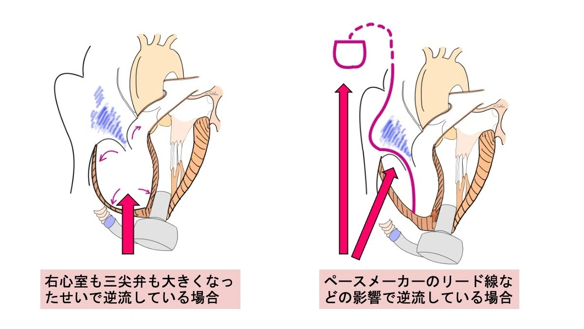 [LVAD手術] 三尖弁形成術は補助人工心臓（LVAD）装着時に行った方がいいのか？ -｜心臓外科 田所 直樹 M.D., Ph.D.