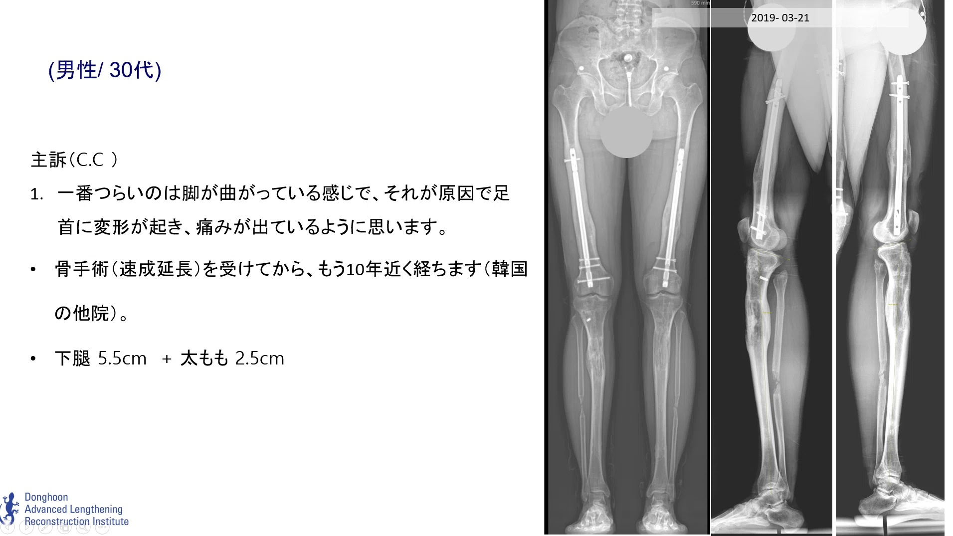 身長延長手術における「足首スクリュー」の重要な役割｜ドンフン病院