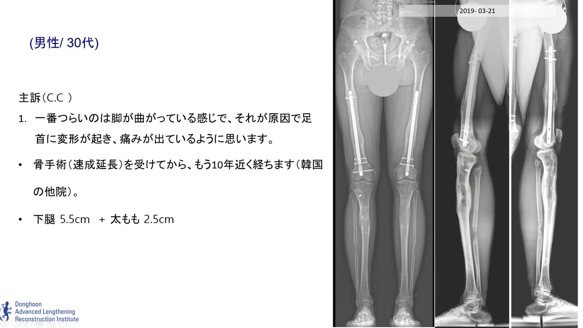 身長延長手術における「足首スクリュー」の重要な役割｜ドンフン病院