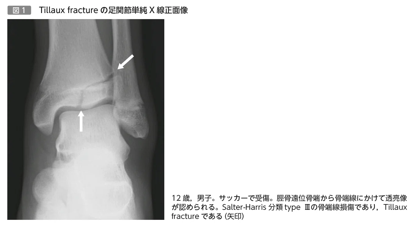 第37回 単純X線像で診断できる骨端線損傷：Tillaux骨折｜メジカルビュー社