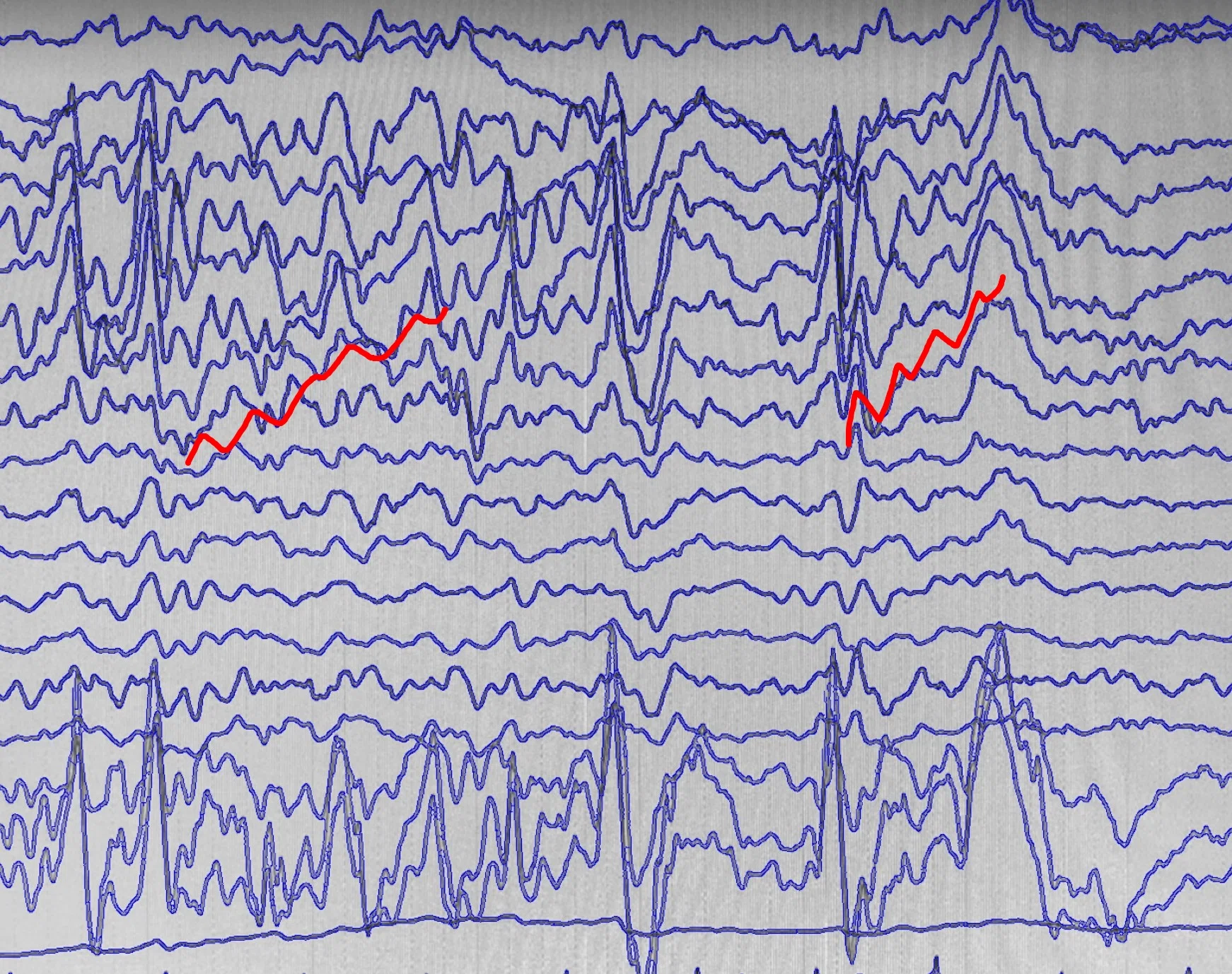 eeg 2011年 Differences between sleep EEG and epileptiform discharges