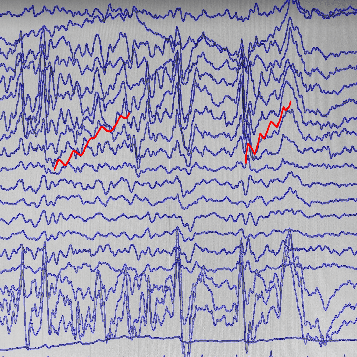 睡眠脳波とてんかん性放電の違い｜はじめての脳神経内科・脳波・てんかん